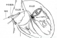 原创技术，推陈出新——心外科成功解决大型二尖瓣瓣周漏封堵难题