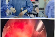 脊柱外科团队完成院内首例ULIF腰椎微创手术