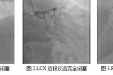 心内二科完成医院首例stingary球囊辅助ADR开通CTO病变，历经5次介入手术成功救治一名等待心脏移植的终末期患者