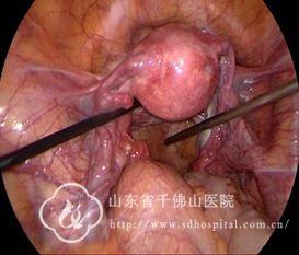 妇科完成一例腹腔镜下骶前神经鞘瘤切除手术
