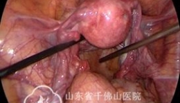 妇科完成一例腹腔镜下骶前神经鞘瘤切除手术