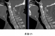 多节段脊髓型颈椎病（MCM）治疗新武器——centerpiece微型钢板