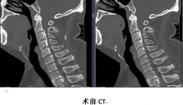 多节段脊髓型颈椎病（MCM）治疗新武器——centerpiece微型钢板