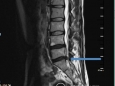 脊柱外三科完成医院首例经Vista通道显微镜辅助腰椎髓核摘除术（MASS）