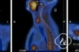 核医学科开展甲状旁腺SPECT/CT融合显像新技术