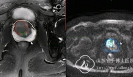 泌尿外一科开展多参数磁共振融合超声引导前列腺癌放射性粒子植入术
