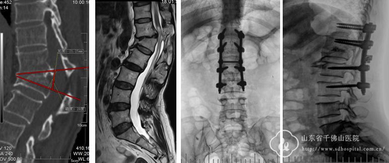 脊柱外一科成功开展截骨矫形手术治疗复杂脊柱畸形患者