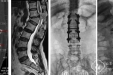 脊柱外一科成功开展截骨矫形手术治疗复杂脊柱畸形患者