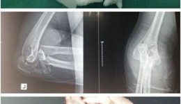 创伤外科完成首例3D打印技术辅助下严重陈旧性肘关节骨折脱位手术