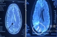 神经外4科成功实施脑立体定向活检术1例