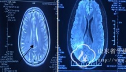 神经外4科成功实施脑立体定向活检术1例