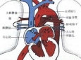 心外科完成省内首例低体重双胎早产儿完全超声引导下经胸肺动脉瓣球囊扩张术