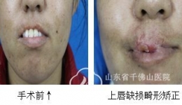 整形外科应用下唇部带蒂轴型组织瓣转移修复上唇缺损畸形