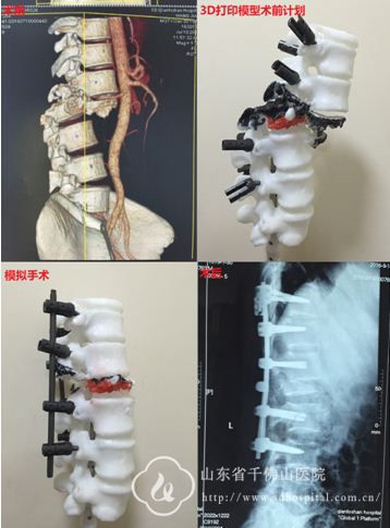 脊柱外科成功利用3D打印技术为一脊柱骨折、重叠移位患者进行手术治疗