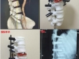 脊柱外科成功利用3D打印技术为一脊柱骨折、重叠移位患者进行手术治疗