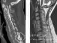 脊柱外科利用3D打印技术辅助完成1例复杂高危颈椎手术