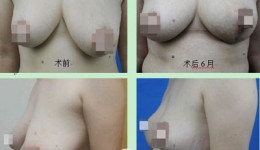 整形外科在全省率先开展内侧真皮乳腺蒂乳房缩小术
