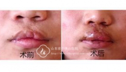 整形外科成功开展唇鼻三维肌肉立体重建技术修复唇裂畸形