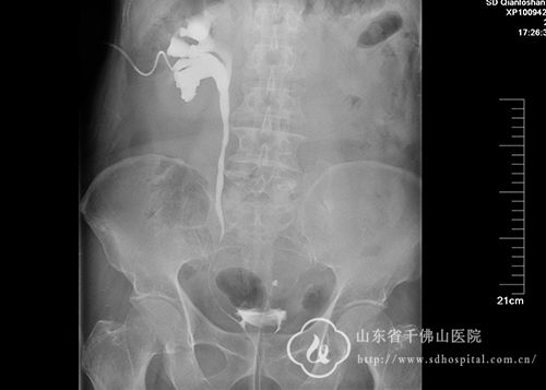 泌尿外三科完成省内首例双支架套叠治疗长段输尿管狭窄手术