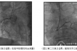 心内二科完成山东首例ECMO辅助下急诊PCI