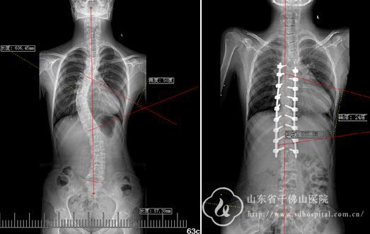 脊柱外三科开展3D打印辅助下脊柱侧弯矫形手术