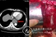 胸外二科近日完成两例巨大食管肿瘤切除术