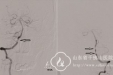 回天有“术”—记神经外一科一例双侧椎动脉多发狭窄患者