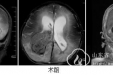 神经外三科成功为2月龄婴儿脑室巨大肿瘤并脑积水实施手术