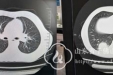 小儿血液内分泌科亲缘单倍体造血干细胞移植成功救治一例重症MDS患儿