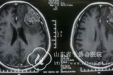 边手术边与患者实时交流  保全患者语言运动功能