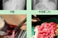 小儿外科成功治愈一例先天性膈疝患儿