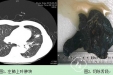 胸外二科完成1例高龄患者肺癌肺段切除术