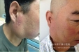 我院首例神经外科杂交手术治愈罕见头面颅颈部巨大动静脉瘘