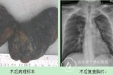 胸外二科成功完成一例重症肺功能障碍肺癌手术