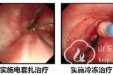 呼吸科联合疗法完成一例老年严重气道狭窄介入治疗