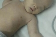 儿童重症监护室确诊婴儿腺垂体功能减退1例