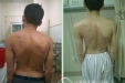 脊柱外科完成一例神经纤维瘤病并脊柱侧凸手术