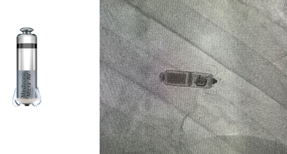 心内科心律失常团队完成院内首例Micra AV无导线双腔起搏器植入术