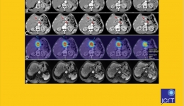 重磅！！！！！英文版—《影像引导下肿瘤热消融治疗原发性及转移性肺部肿瘤临床指南》正式发布