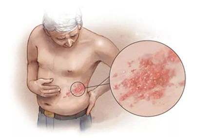 疼痛科提醒—警惕带状疱疹及相关性疼痛
