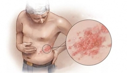 疼痛科提醒—警惕带状疱疹及相关性疼痛