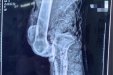 医院骨创伤外科成功救治一例膝关节离断伤患者