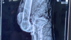 医院骨创伤外科成功救治一例膝关节离断伤患者