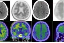 我院Aβ-PET显像助力阿尔茨海默病精准诊断和治疗