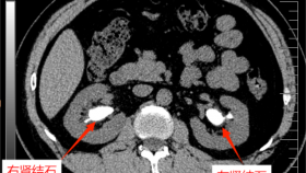 双侧无积水铸型复杂肾结石如何做到一次手术达到99.64%清石率？泌尿外科带您了解