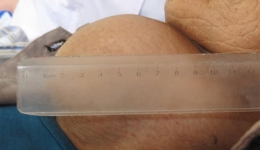 两腺外科成功手术治疗一例巨大结节性甲状腺肿