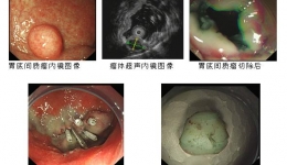 我省首例固有肌层来源的胃底间质瘤于内镜下成功切除