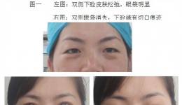 我院首例“内切法”眼袋整形术成功实施
