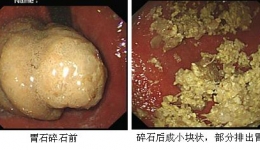 空腹进食山楂致胃结石 内镜碎石免除动刀开腹之痛