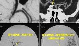 我院神经外科微小动脉瘤综合诊疗技术取得新进展